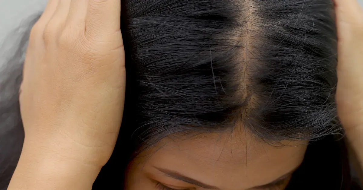 Woman with thinning hair and poor scalp health.