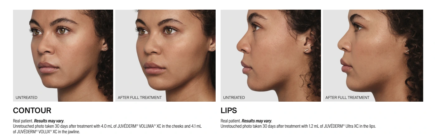 Juvederm before and after.