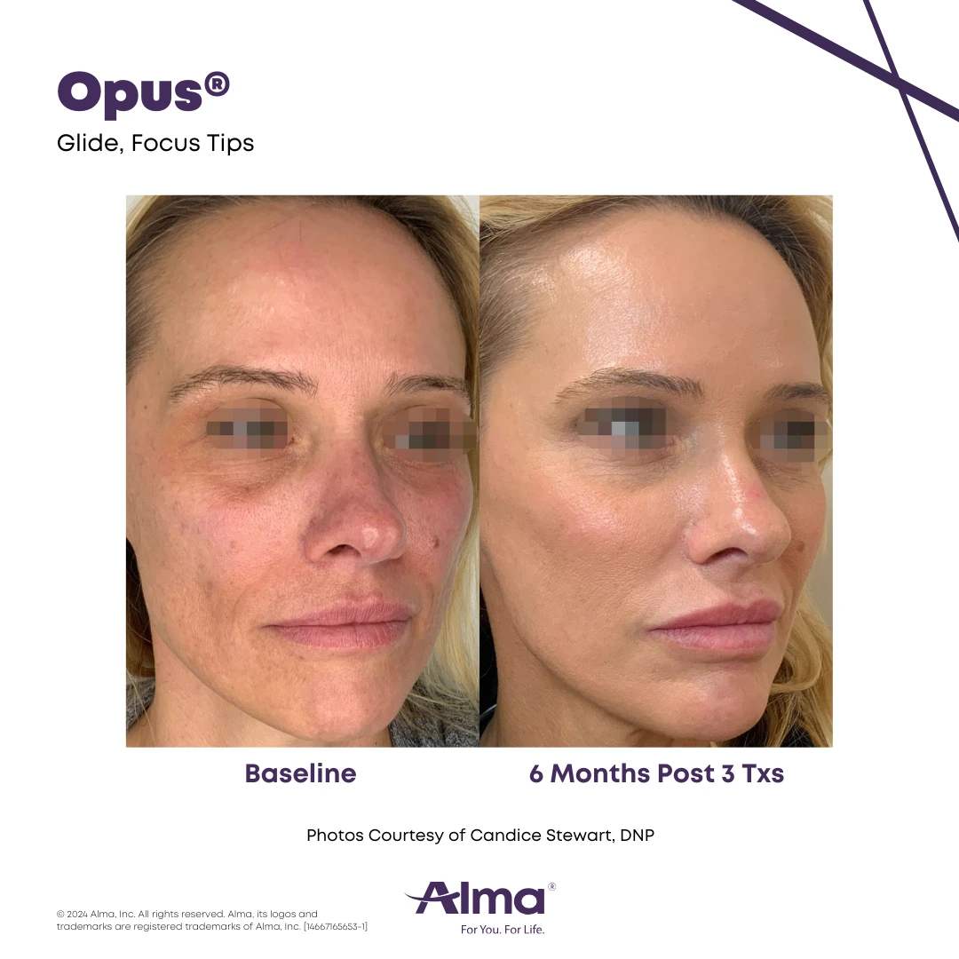 Opus Plasma before and after on a patient with a light skin tone.