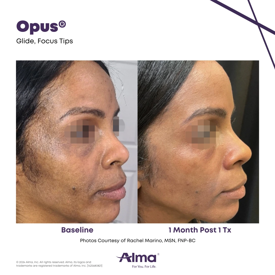 Opus Plasma before and after on a patient with a dark skin tone.
