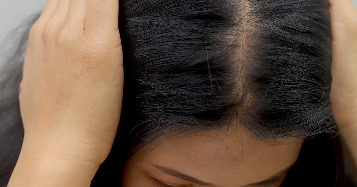 Woman with thinning hair and poor scalp health.